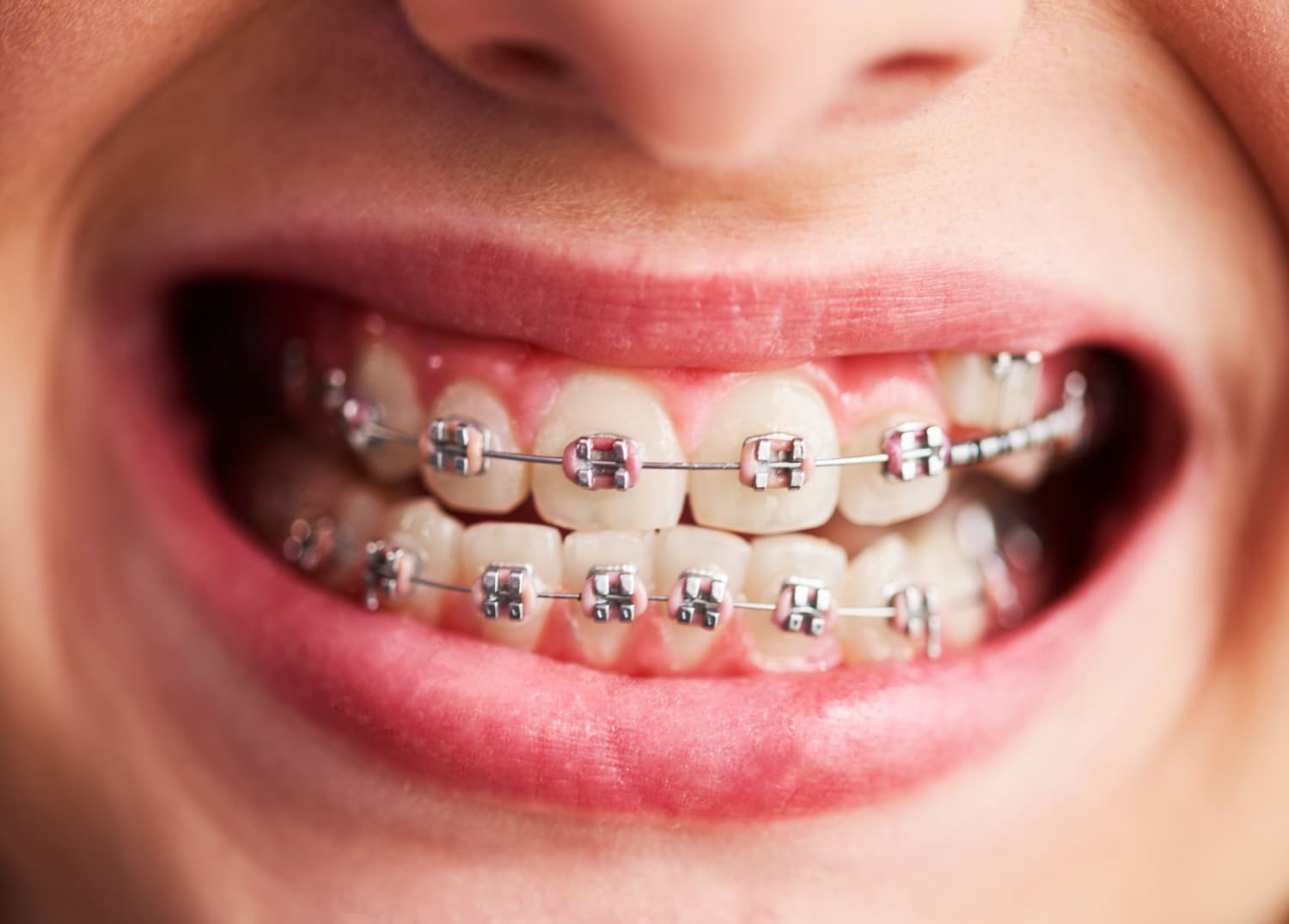 Insurance Cover Braces